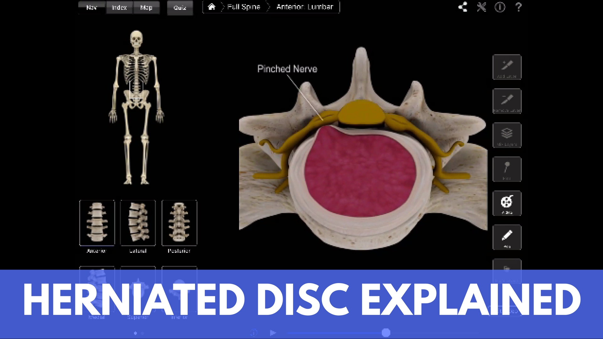 What is a Lumbar Disc Herniation? How to Treat It Without Surgery.