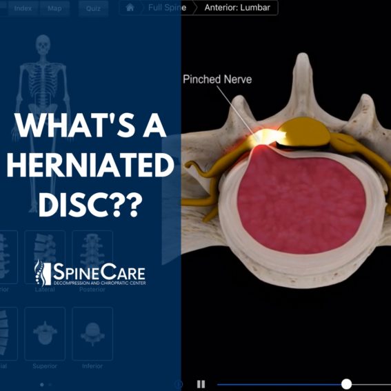 What is a herniated disc