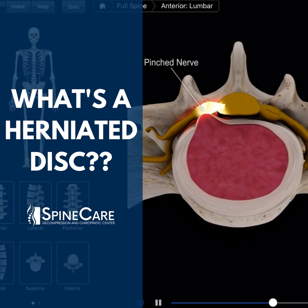 What Is a Herniated Disc? SpineCare St. Joseph, MI Chiropractor
