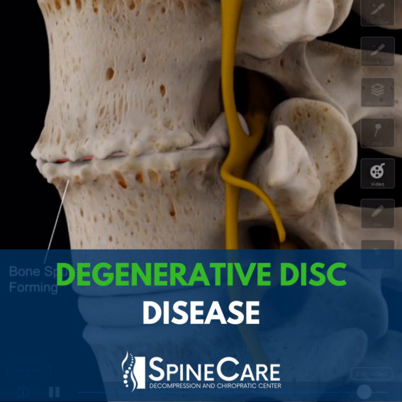 Degenerative Disc Disease Causes