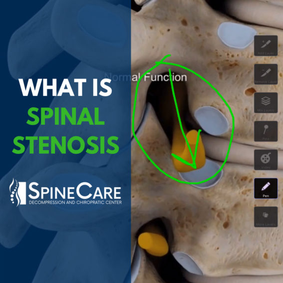 What is Spinal Stenosis St. Joseph MI Chiropractor