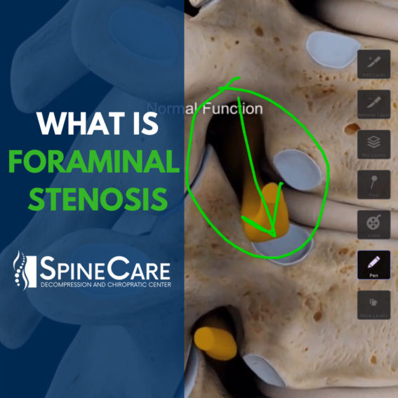 Foraminal stenosis St. Joseph, MI chiropractor