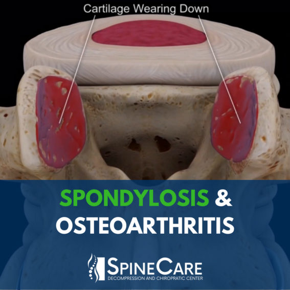 OSTEOARTHRITIS & SPONDYLOSIS St. Joseph MI chiropractor