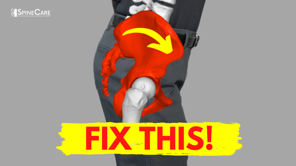 How to Fix Anterior Pelvic Tilt for Good | SpineCare | St. Joseph, Michigan Chiropractor