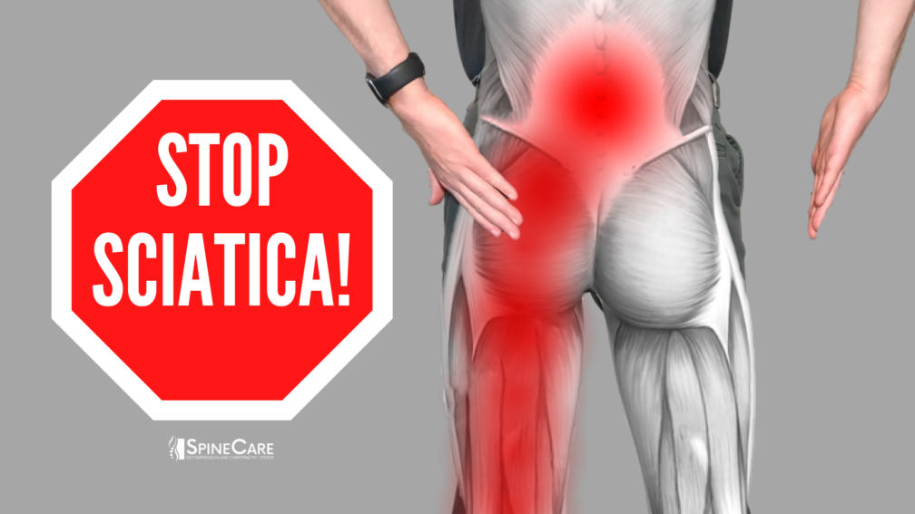 How to Relieve Sciatica Pain in SECONDS | SpineCare | St. Joseph, Michigan Chiropractor