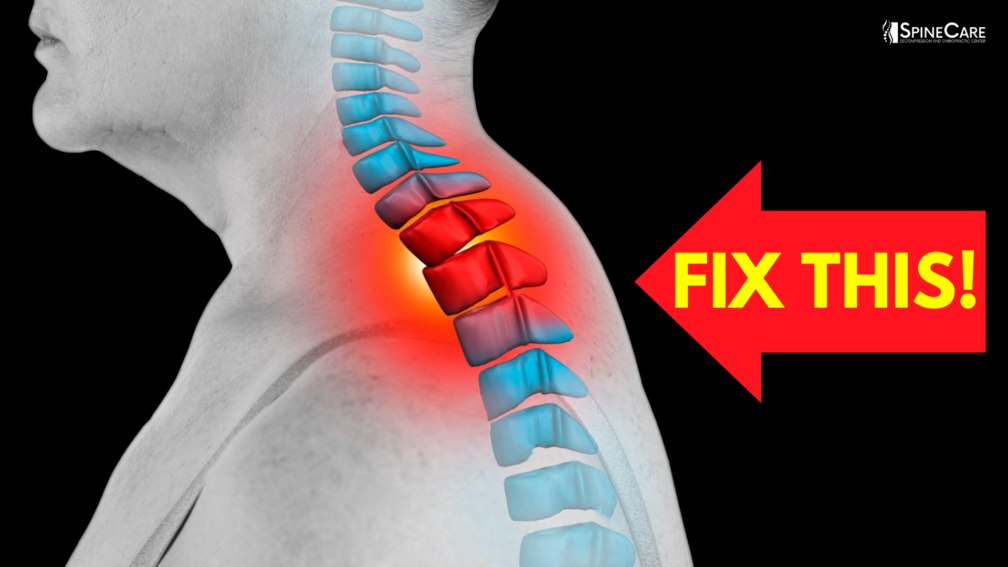 How to Fix a Neck Hump at Home | SpineCare | St. Joseph, Michigan Chiropractor