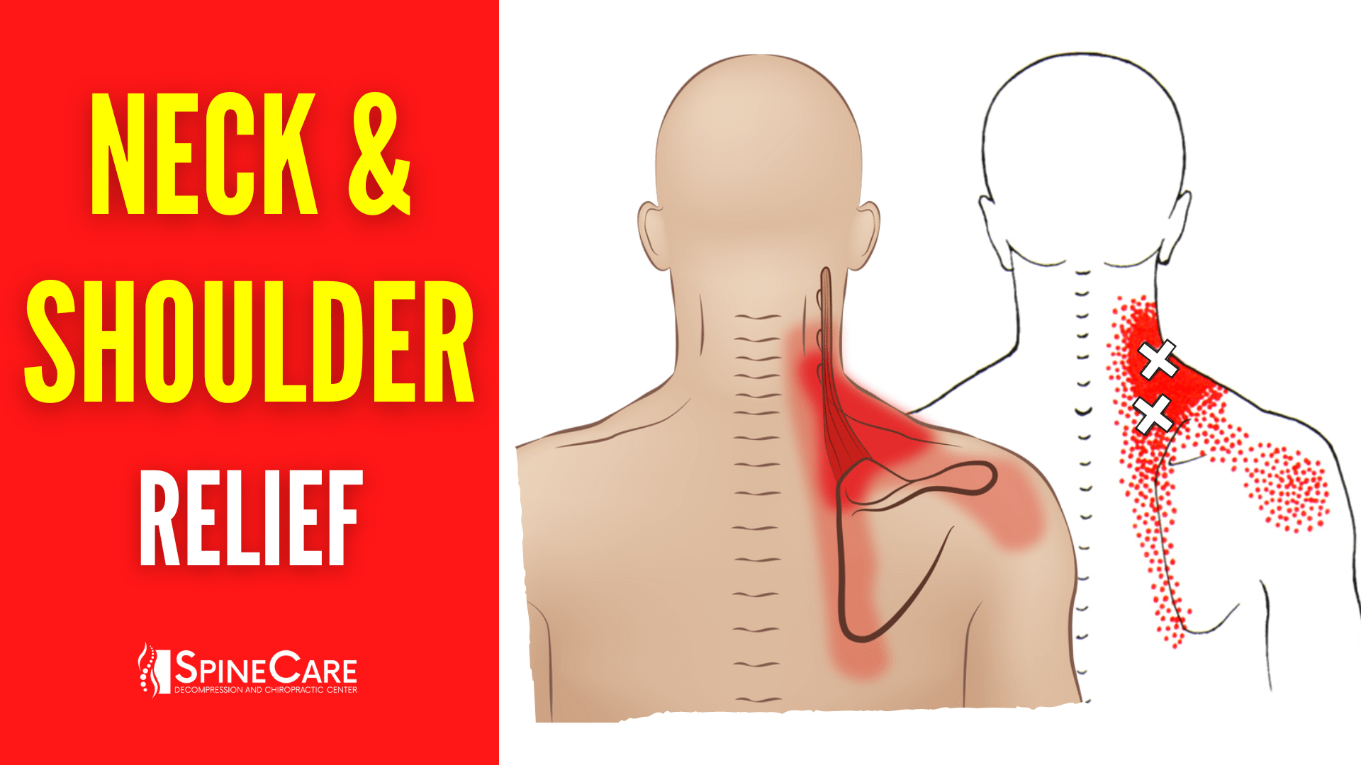 How to Fix Neck and Shoulder Pain FOR GOOD | SpineCare | St. Joseph, Michigan Chiropractor