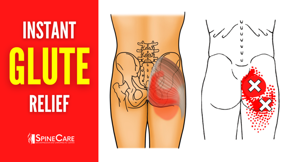 How to Fix Glute Pain FOR GOOD | SpineCare | St. Joseph, Michigan Chiropractor