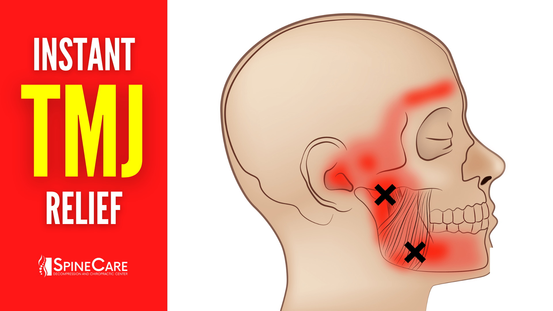 How to Relieve TMJ Pain at Home | SpineCare | St. Joseph, Michigan Chiropractor