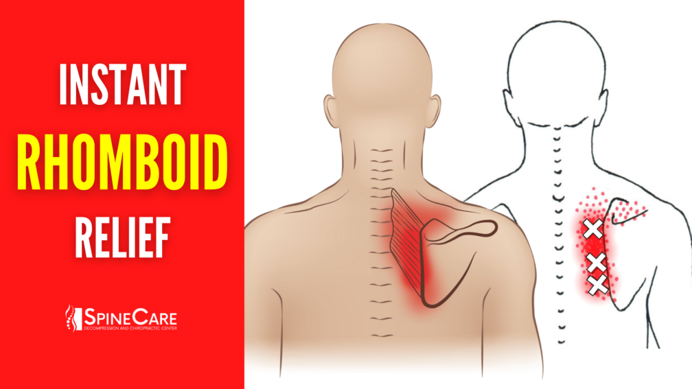 How to Fix Rhomboid Pain FOR GOOD | SpineCare | St. Joseph, Michigan Chiropractor