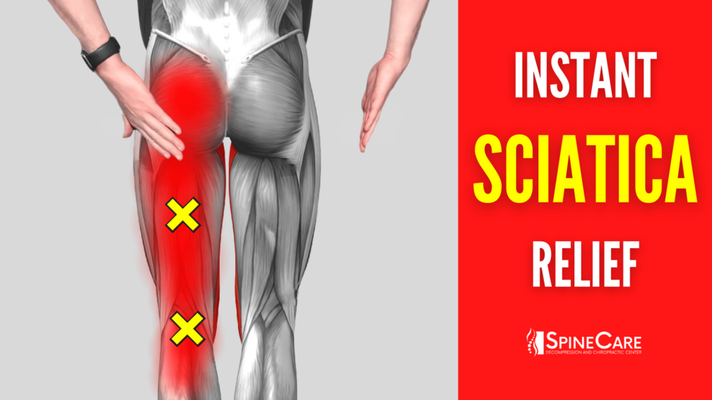 How to Fix Sciatica Pain at Home | SpineCare