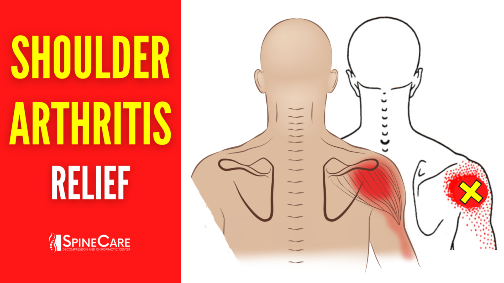 How to Relieve Shoulder Arthritis Pain in 30 SECONDS | SpineCare | St. Joseph, Michigan Chiropractor