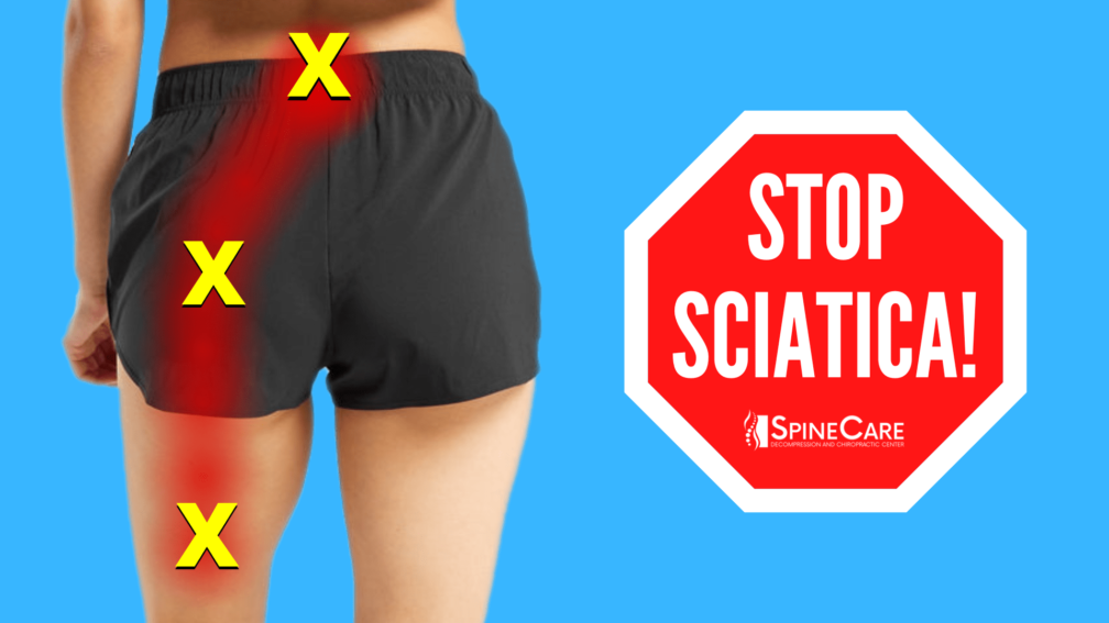 How to PREVENT Sciatica Leg Pain | SpineCare | St. Joseph, Michigan Chiropractor