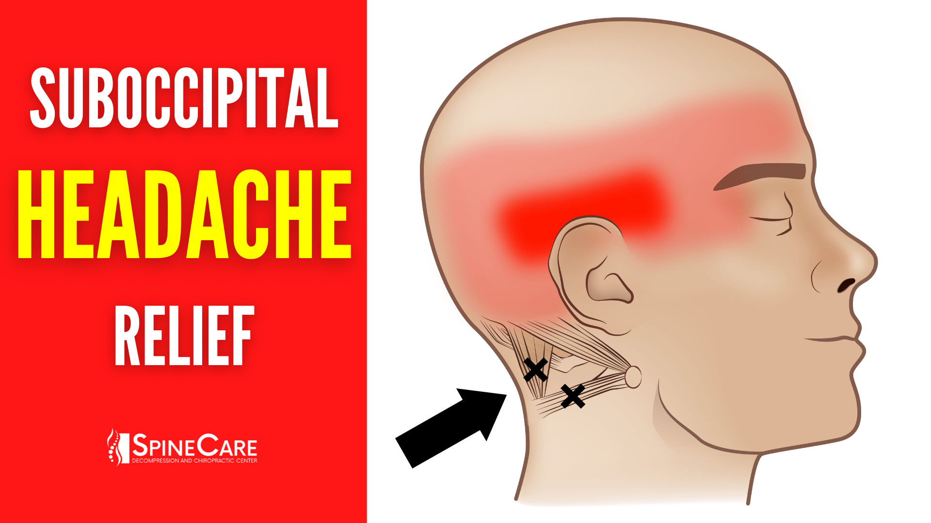 How to Release Tight Suboccipital Muscles