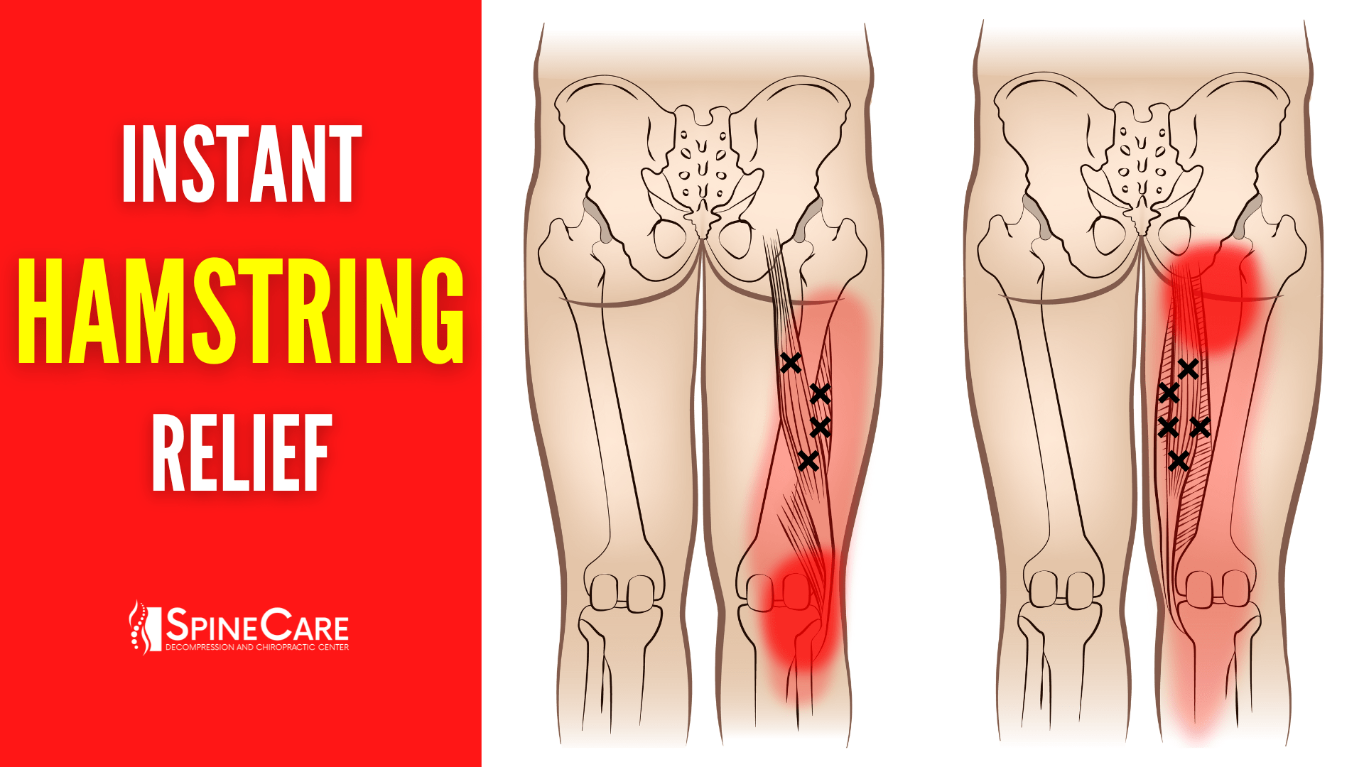 How to Fix Hamstring Pain FOR GOOD | SpineCare | St. Joseph, Michigan Chiropractor