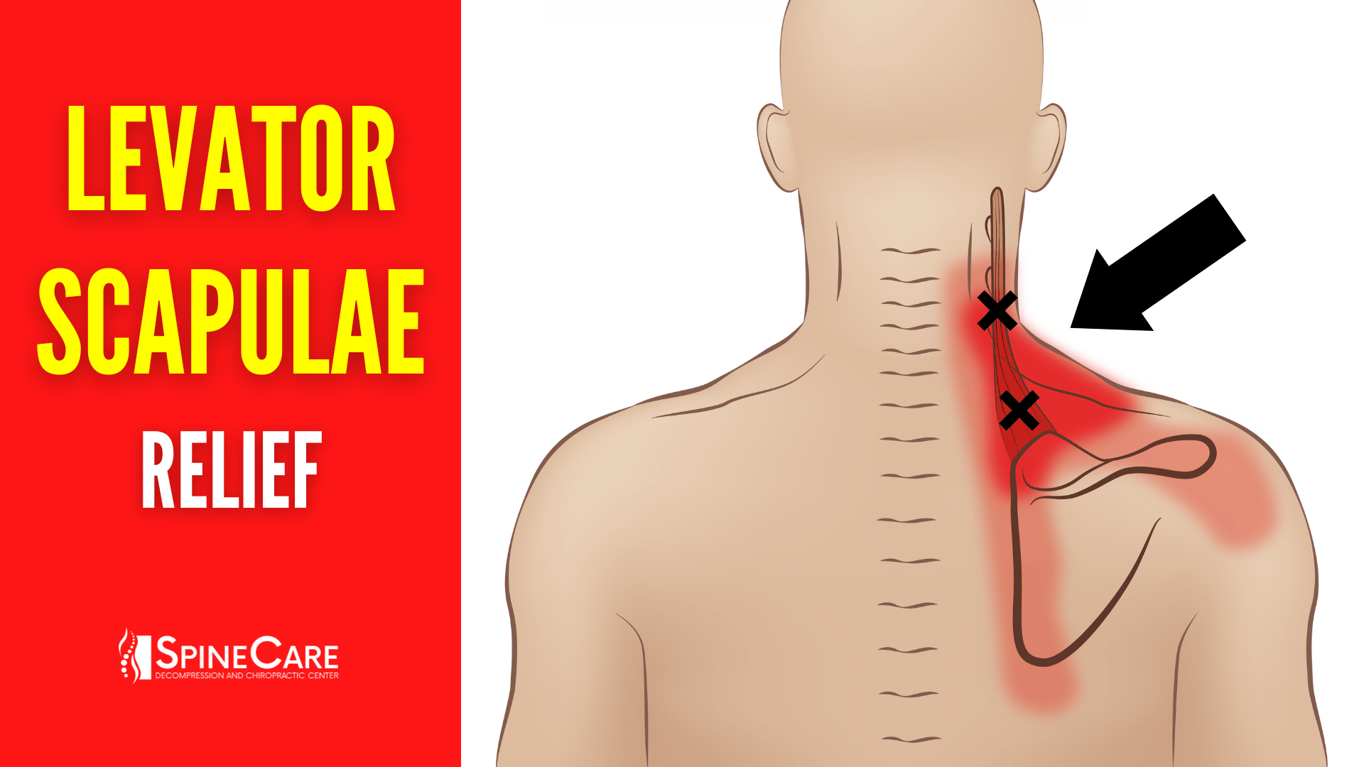 How to Fix Levator Scapulae Pain FOR GOOD | SpineCare | St. Joseph, Michigan Chiropractor