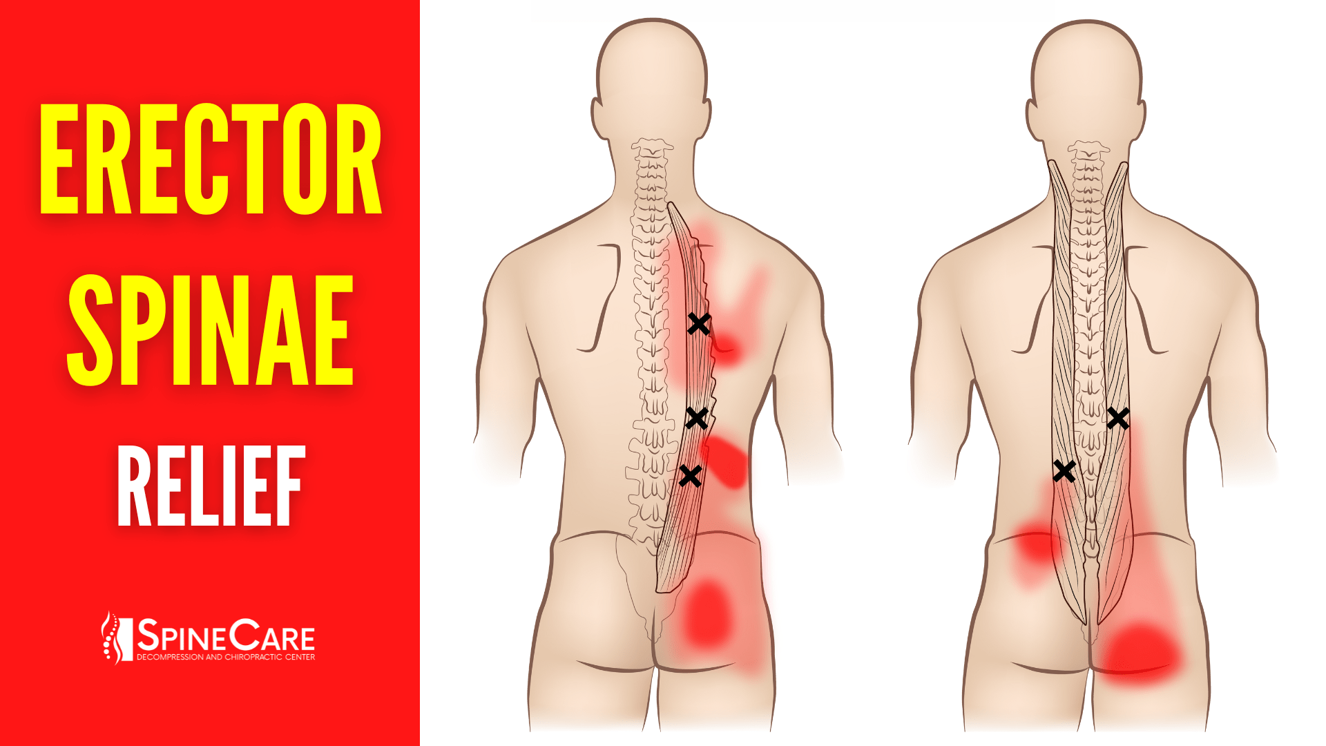 How to Fix Erector Spinae Pain FOR GOOD | SpineCare | St. Joseph, Michigan Chiropractor